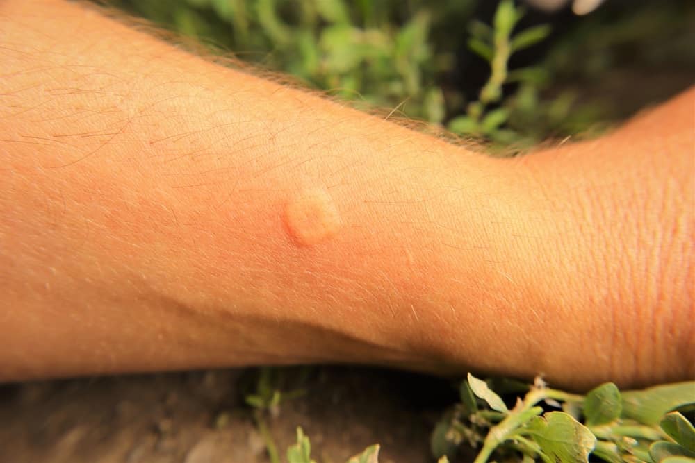 Red, swollen skin after a wasp sting