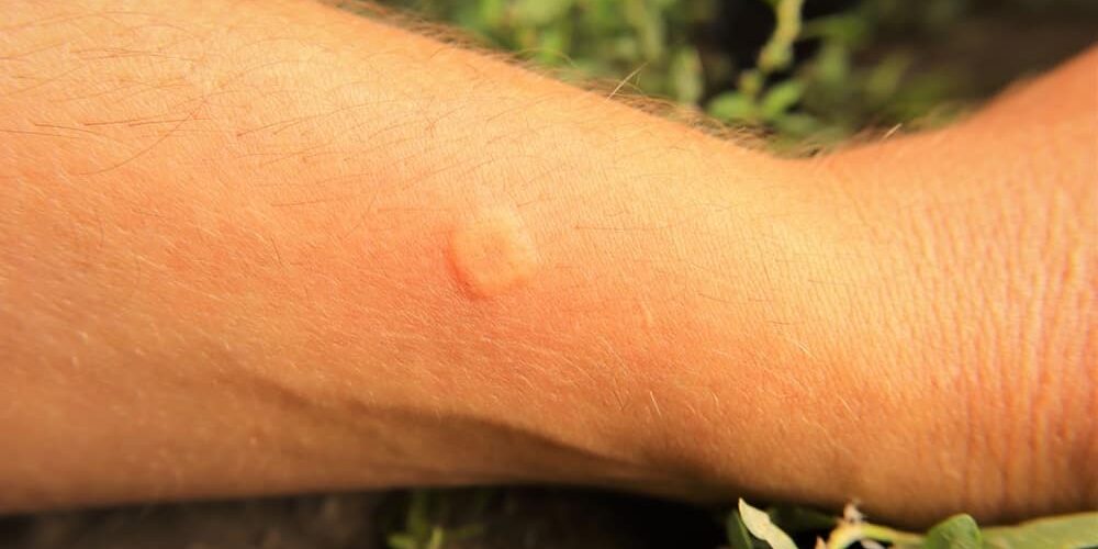 skin allergy stung by a wasp