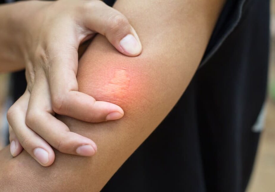 Close-up of bee sting in human skin