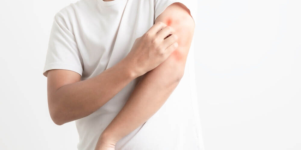 Man itching and scratching his arm from allergy